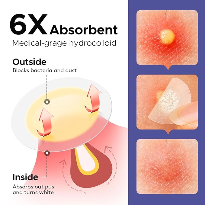 LitBear Acne Patches for Large Breakouts, Hydrocolloid Pimple Patches for Zit and Blemish, Face, Chin, Back and Body With Tea Tree Oil