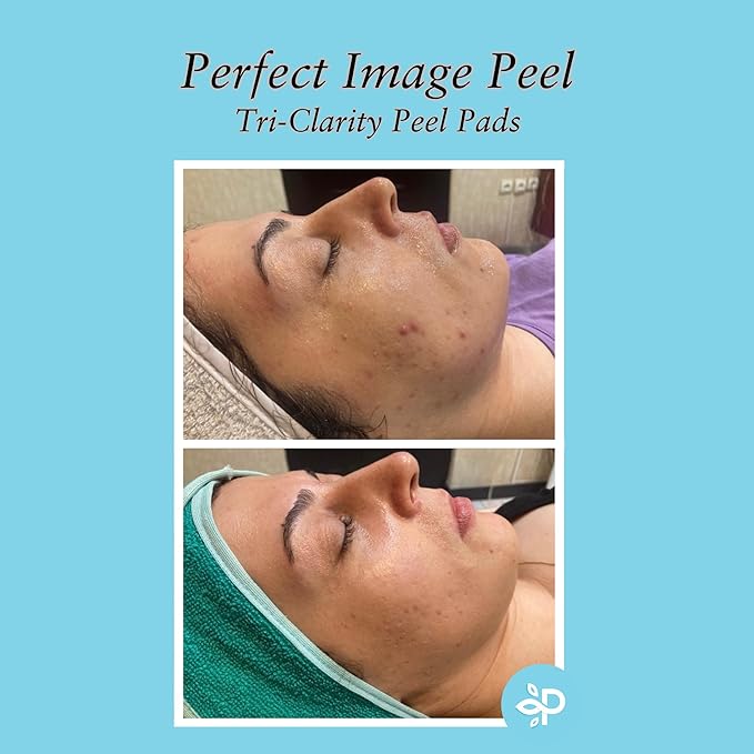 Tri-Clarity Peel Pads, Enhanced with Salicylic Acid, Mandelic Acid, Tea Tree Oil, Green Tea Extract (25% Strength Level)