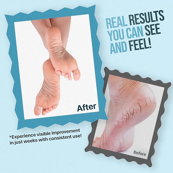 Urea Cream for Feet - Maximum Strength 42% Foot Cream for Calluses and Dry Feet - Free Pumice Stone and Brush - Shea and Mango Butters-Paraben Free-Fragrance Free- 4oz.