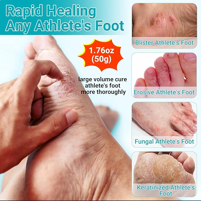 Athletes Foot Treatment Cream, Maximum Strength for Athlete's Foot (Tinea Pedis), Itching, Blister, Burning, Cracking, Scaling, Beriberi,Natural Herbs Antifungal Foot Cream
