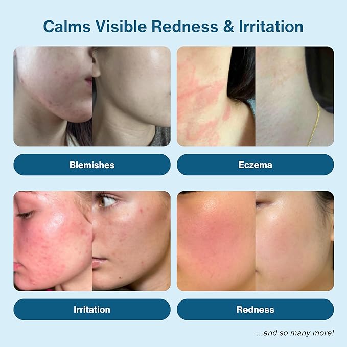 Hypochlorous Acid Spray – Eyelid Cleanser, HOCl Face & Skin Mist for Acne, Eczema & Irritation – Multi-Purpose Skin Repair – Post-Workout, Scalp & Sensitive Skin, Travel Size - 2 oz