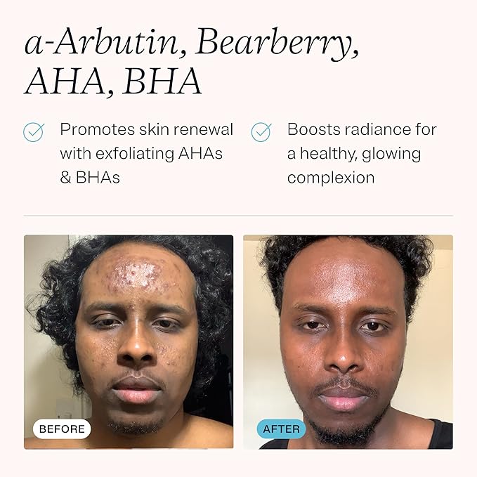 MDacne Dark Spot Remover For Face & Body, 40ml (3-Pack) - Improves Skin Brightness, Texture & Tone, Oil-Free for Sensitive & Acne-Prone Skin, AHA & BHA Enhances Skin Radiance, Dermatologist Formulated