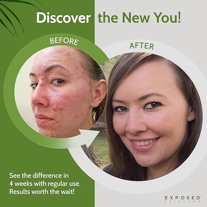 Exposed Skin Care, Basic Acne Treatment Kit with 2.5% Salicylic Acid and 3.5% Benzoyl Peroxide to Clear Up Teen, Adult, Hormonal and Cystic Acne – Natural, Non-toxic and Cruelty Free