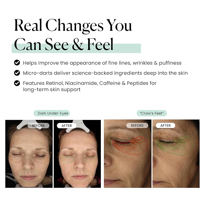 Qure Skincare MicroInfusion Targeted Patches - 8 Pairs of Targeted Under Eye Patches Formulated for Fine Lines & Wrinkles - Retinol, Caffeine, Niacinamide & Peptides - Dissolvable for Overnight Use