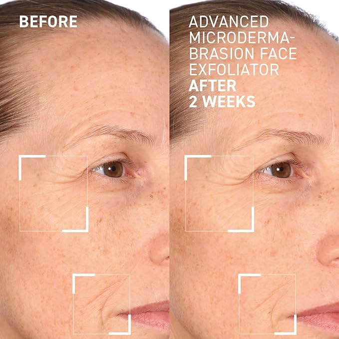 Dr. Brandt Advanced Microdermabrasion Face Exfoliator - Refines Texture, Minimizes the Look of Fine Lines & Enhances Overall Skin Tone - 2 oz
