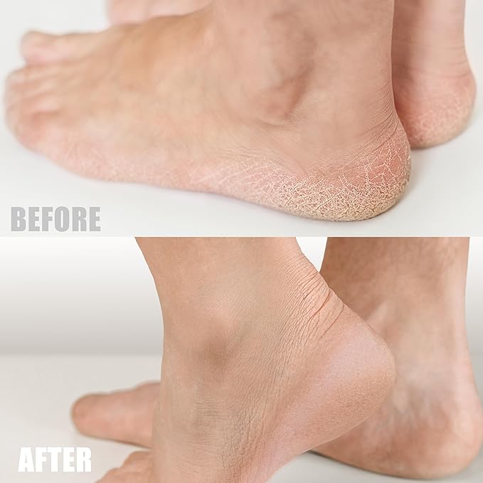 TriDerma Tea Tree Oil Foot Cream for Dry Cracked Feet, Itchy Skin, Tingling & Foot Pain with Menthol, Non-greasy 9.5 oz