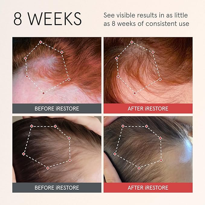 iRESTORE Scalp Serum | Hair Growth Serum for Women Men | Best for Hair Loss Hair Thinning | Aids Regrowth with Redensyl Biotin | Hydrates Scalp for Visibly Thicker Stronger Hair (2 Fl Oz, Pack of 3)
