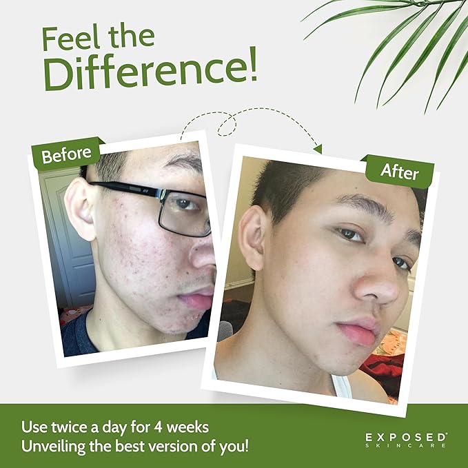 Exposed Skin Care, Expanded Acne Treatment Kit with 2.5% Salicylic Acid and 3.5% Benzoyl Peroxide to Clear Up Teen, Adult, Hormonal and Cystic Acne – Natural, Non-toxic and Cruelty Free