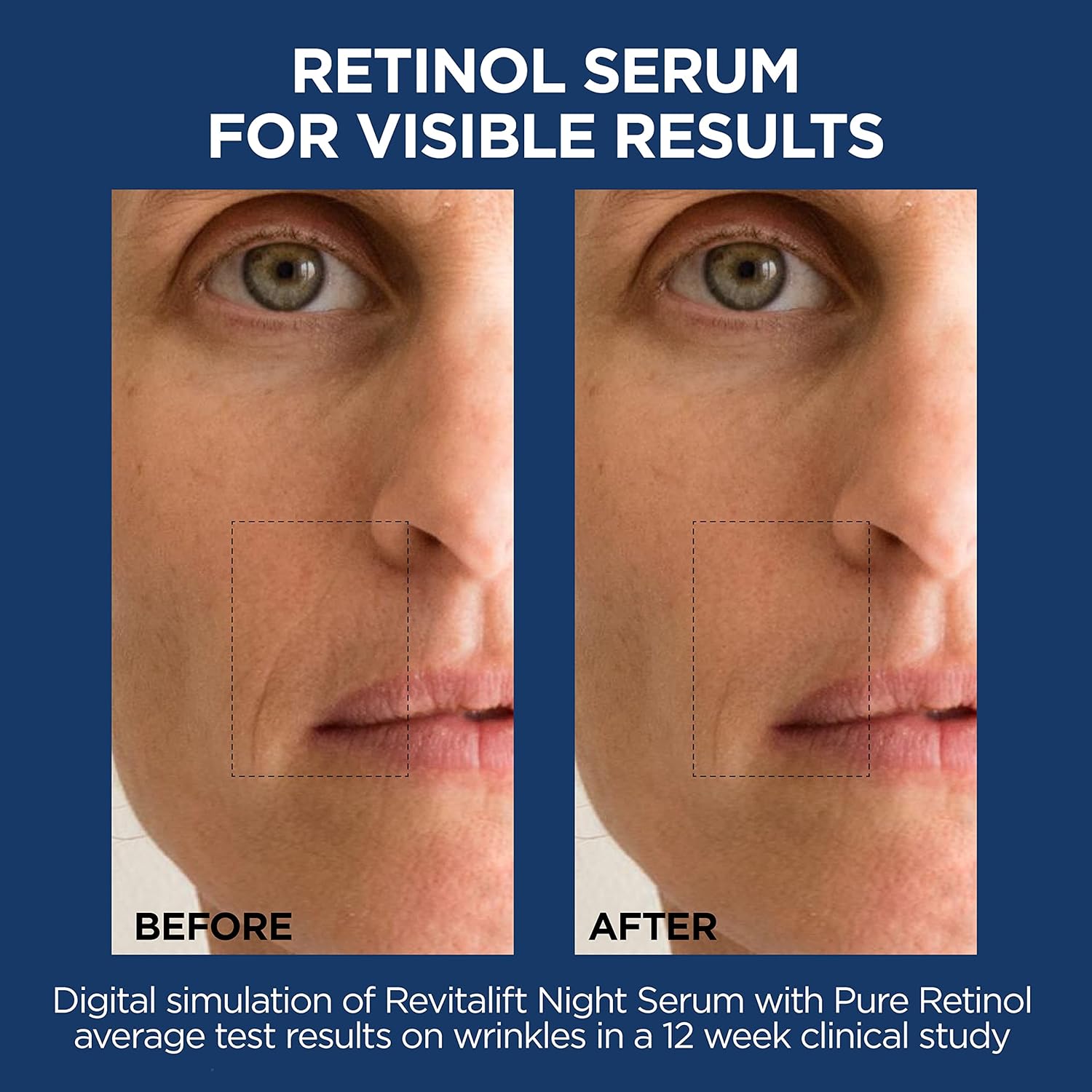 Revitalift Hyaluronic Acid & Retinol Night Serum Kit – 2-Piece Set ✨💧