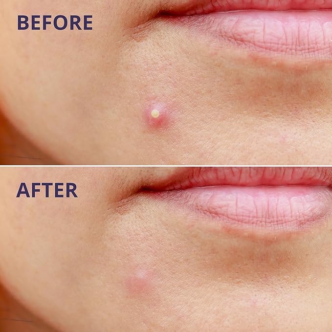 Pimple Patches for Face (96 Count). Invisible Hydrocolloid Acne Patch for Blemishes, Zits, and Breakouts. Easy-to-Use Spot Cover for Day & Night, One Size - Medium (12mm)