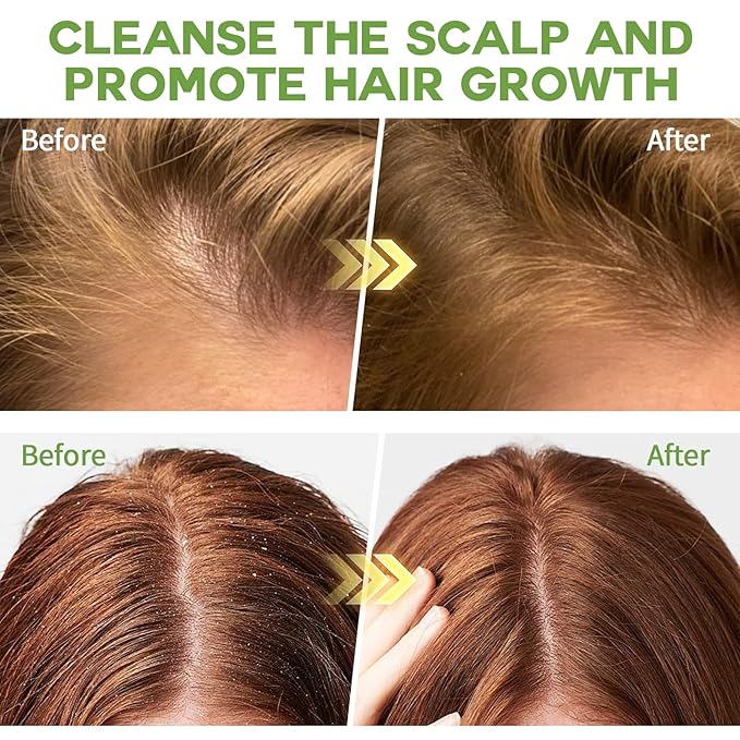 Rosemary Scalp Exfoliator & Clarifying Shampoo Scalp Scrub - 3-in-1 Scalp Treatment with Mint Oil Hair Treatment to Clarify and Remove Build Up - Silicone Scalp Massager Rosemary Oil for Hair Growth