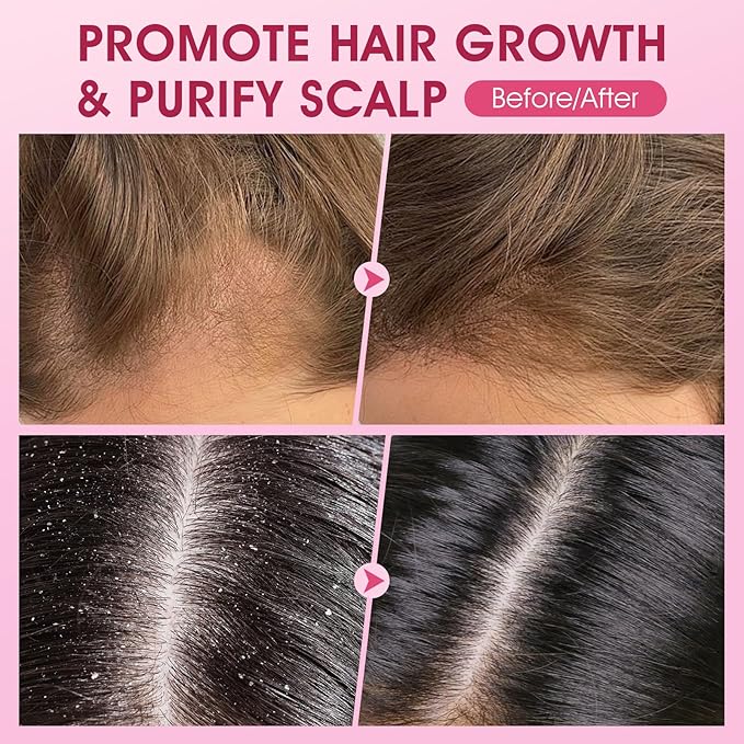 Scalp Scrub, Onion Scalp Exfoliator Shampoo, 2-in-1 Scalp Treatment with Biotin, Hair Treatment to Clarify and Remove Build Up, 10.6oz/300g