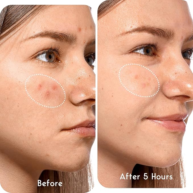 LitBear Acne Patches Large, Hydrocolloid Pimple Patches for Breakouts, Zit and Blemish, Acne Patches for Face, Chin, Back and Body with Tea Tree Oil