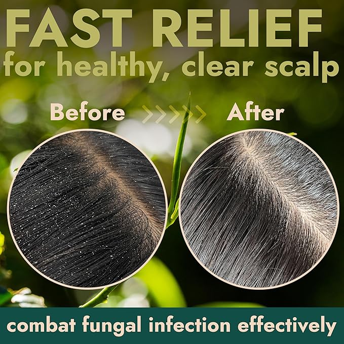 Tea Tree Scalp Scrub | Antifungal Itchy Scalp Treatment with Tea Tree Oil, Quartz Powder & Sea Salt | Gently Exfoliates, Relieves Dryness, Fights Dandruff, Promotes Healthy Hair Growth & Scalp Relief